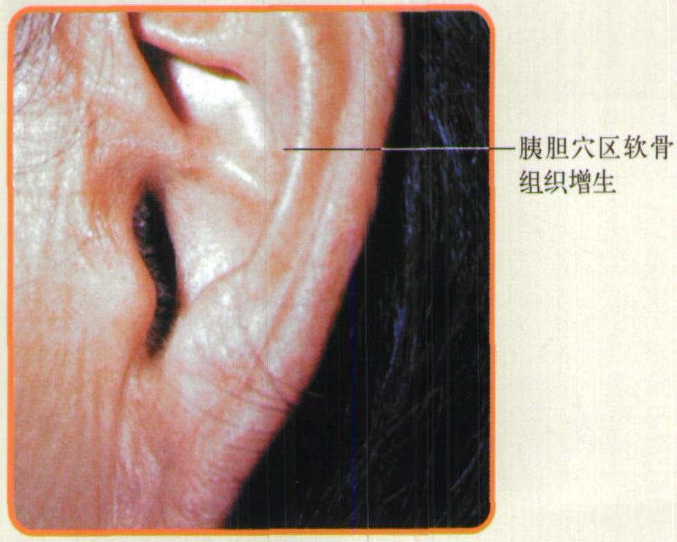 第十一節(jié) 膽囊炎